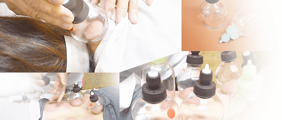 カッピング療法のイメージ